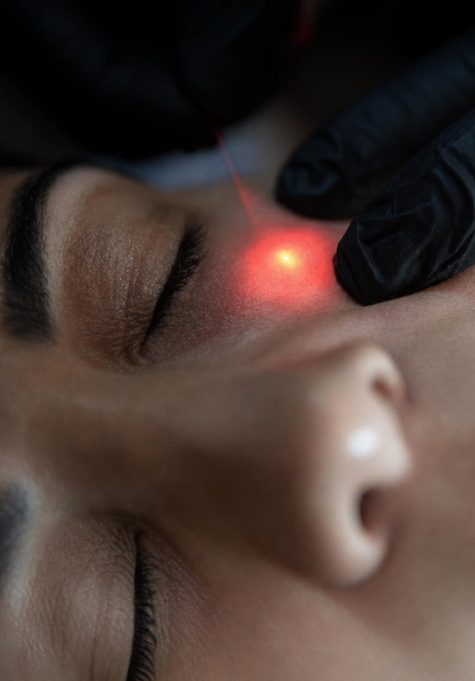 ENDOLIFT